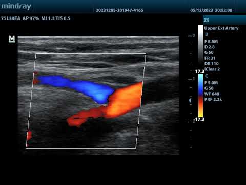 Normal brachial artery and bifurcation to radial and ulnar artery