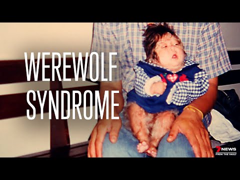 Living with ‘Werewolf Syndrome’ | Sunday Night Archive