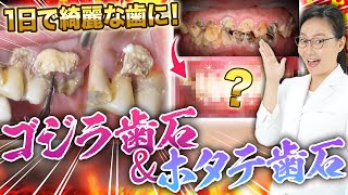 ホタテ化歯石除去とボロボロ虫歯治療～Scallop Tartar Removal and Cavity Treatment🦷