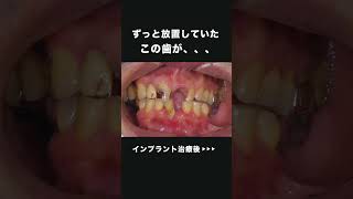 ずっと放置していた歯が、、 #dentalclinic #doctor #インプラント #インプラント治療 #ビフォーアフター