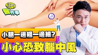 小腿粗細不一樣 ？ 小心可能是 下肢靜脈栓塞 ！恐導致 腦中風 肺栓塞 【江P醫件事#65】