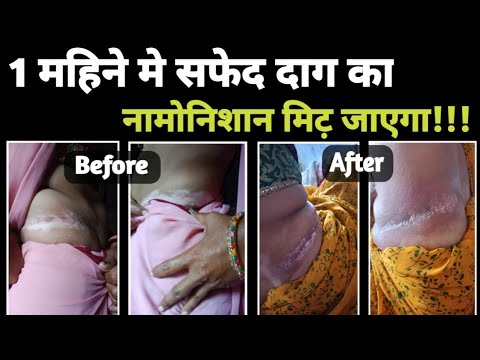 Vitiligo/सफेद दाग इससे असरदार 💯 आयुर्वेदिक इलाज ना है ना होगा❗Vitiligo treatment।।White patches dawa