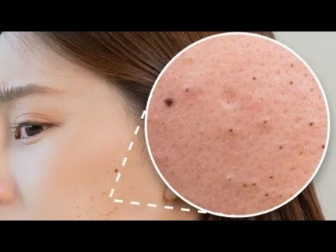 How to Get Rid of Blackheads in Just 7 Days | Top Tips for Quick and Effective Blackhead Removal สิว