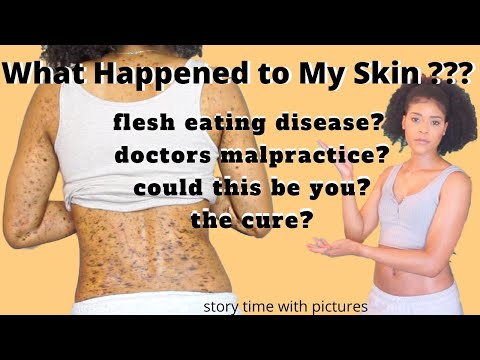 What Happened to My Skin ? | Lichen Planus Treatment | Lichen Planus Cure | Skin Disease