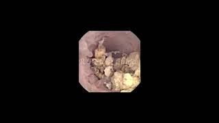 Short Video clip of STEINSTRASSE in upper Ureter | R P Stone Clinic #kidneystonetreatment #rirs