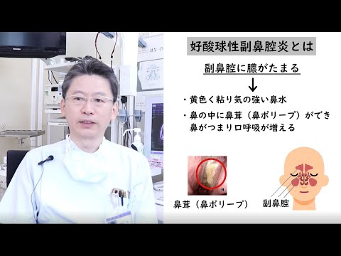 耳鼻咽喉科専門医が教える　好酸球性副鼻腔炎/山口大学病院