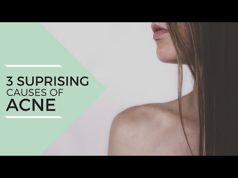 3 Surprising Causes of Acne + Natural Remedies // Laura's Natural Life