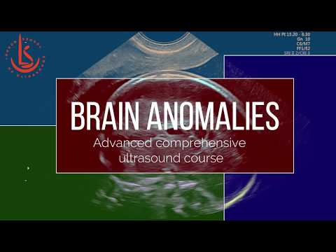 Fetal Neurosonography: Brain development and CNS anomalies.