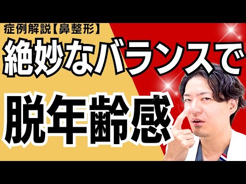 はっしー先生の症例解説！「中顔面の立体感を出して口ゴボが目立たないようにしつつナチュラルで整形感のないお鼻にしてほしい」を叶える！