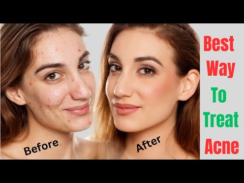 Guide To Understanding And Treating Acne At Home – Best Way to Treat Acne