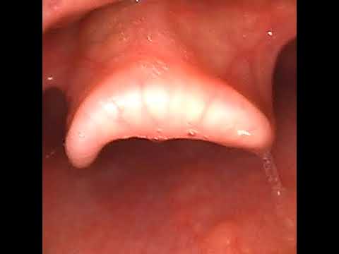 MDH oral intubation video recording via scope 经口教学插管视频