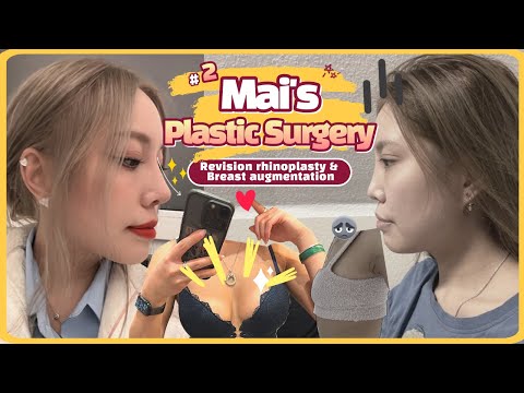 Revision Rhinoplasty & Breast Augmentation at Braun Plastic Surgery PART 2 [with Mai from Germany]