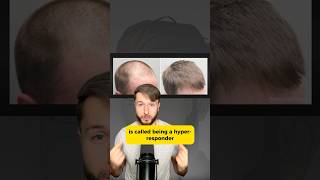 3 Finasteride Hyper-Responder's Secrets! #finasteride #propecia #hairlosstreatment