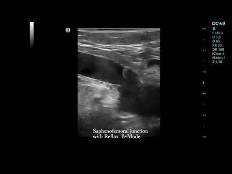 Saphenofemoral junction without and with reflux Duplex Ultrasound