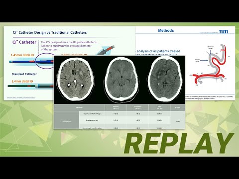 Overcoming Distal Stroke Challenges in Flow, Clot Dislodgement & Ingestion with Next-Gen Catheters