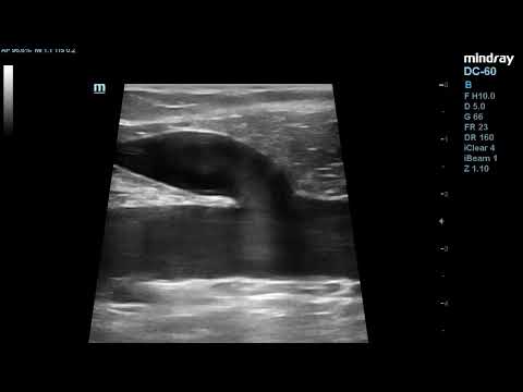 Ultrasound images of common femoral vein and saphenofemoral junction