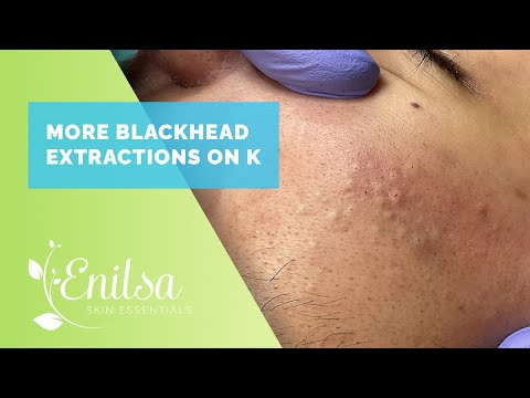 More Blackhead Extractions with K