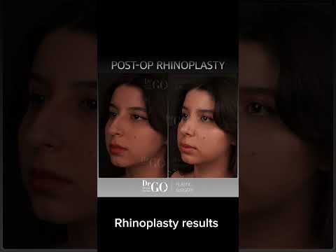 Before and After rhinoplasty - Dr Guncel Ozturk #drgo #beforeandafter #rhinoplastyturkey #nosejob