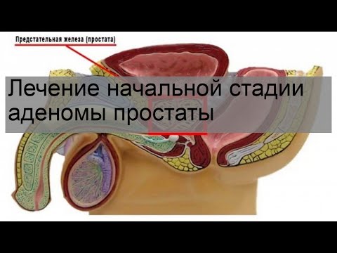 Лечение начальной стадии аденомы простаты