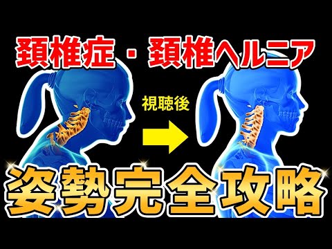 【2024年最新】頚椎症・頚椎ヘルニア姿勢完全攻略【永久保存版】