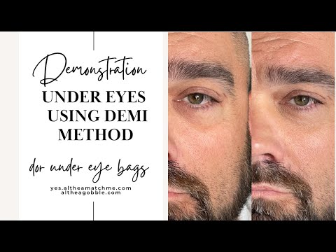 Correcting the under eyes or under bags with Demi Method