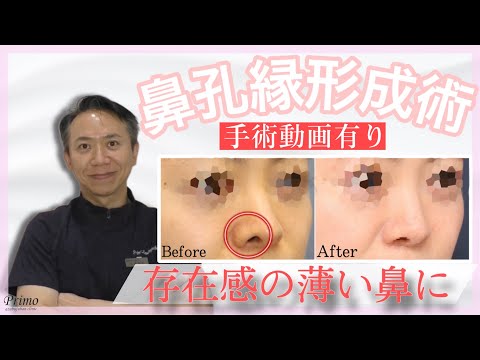 鼻孔縁形成術で存在感の薄い鼻に！！手術動画有り☆