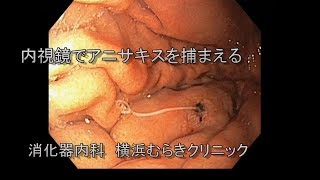 胃アニサキス症 180905「消化器内科　横浜むらきクリニック」