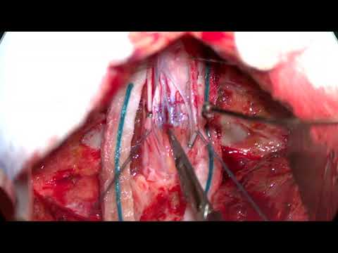 Microsurgical resection of symptomatic intramedullary cervical spinal cord cavernous malformation