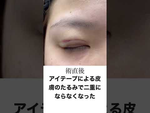 埋没二重＋上瞼の脂肪とり