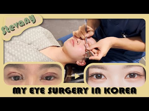 I GOT DOUBLE EYELID SURGERY IN KOREA! I Braun Plastic Surgery