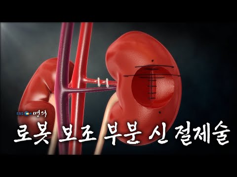 [명의 의학백과📖] 로봇 보조 부분 신 절제술