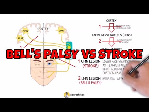 Bell's palsy vs stroke - Facial nerve anatomy - Facial palsy | Neuroaholics