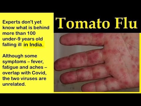 New Tomato Flu Virus (Tomato Fever) in India -- What We Know So Far