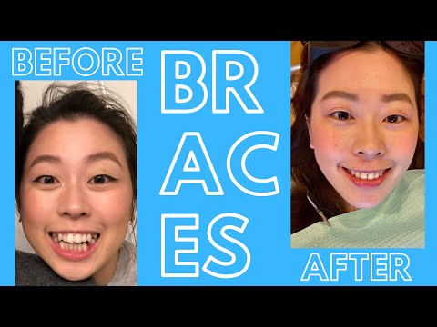 My Braces Journey: Getting them on, off, pain, routine and everything in between