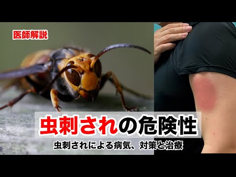 虫刺されの症状や対策、薬や治療法などについて医師が解説します