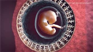 Animated Portrayal of Placenta Accreta Spectrum