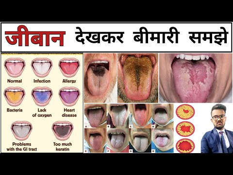 बीमारियां | Tongue colour | Disease | Disease identification | Types of Diseas | Infection | Doctor