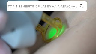 Top 4 Benefits of Laser Hair Removal