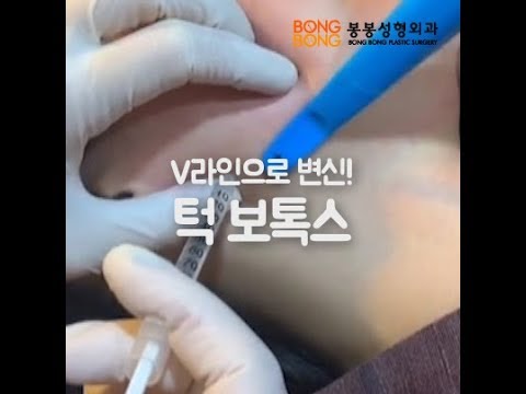 V라인으로 변신! 턱보톡스