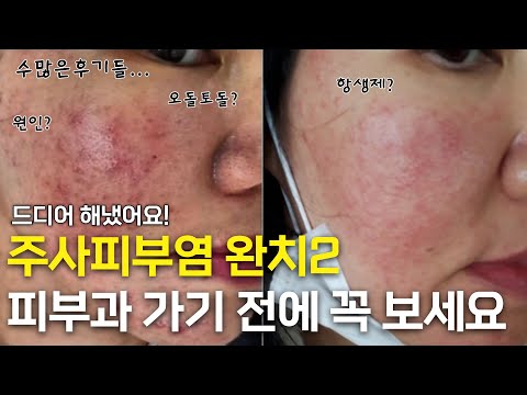 주사피부염극복 완치후기사례 2  항생제/수란트라/엘리델/생활습관/홈케어