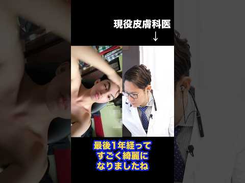 A Man Who Achieved Beautiful Skin by Taking Isotretinoin【Japanese dermatologist】