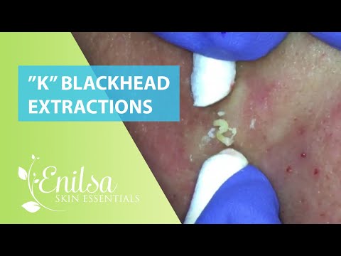 Blackheads Extractions “K’s” 8th Treatment