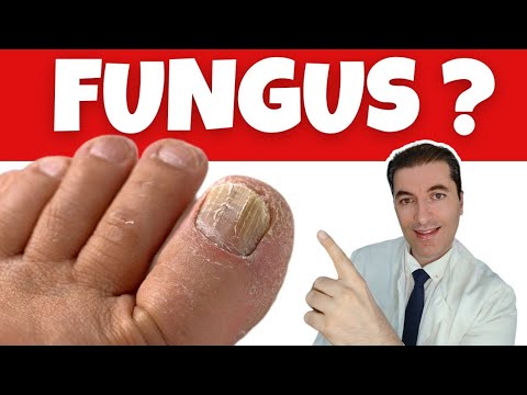 Remove FEET FUNGUS INFECTION In 24 Hours