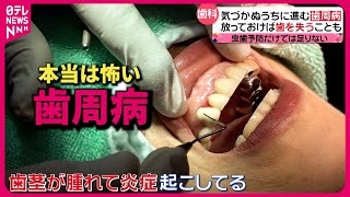 【歯周病】気づかず進行…体内に影響も!? 歯科医が進める治療と予防策は『every.特集』