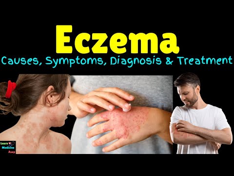 Eczema (Atopic Dermatitis) – Symptoms, Causes, Diagnosis, Treatment, Complications & Prevention