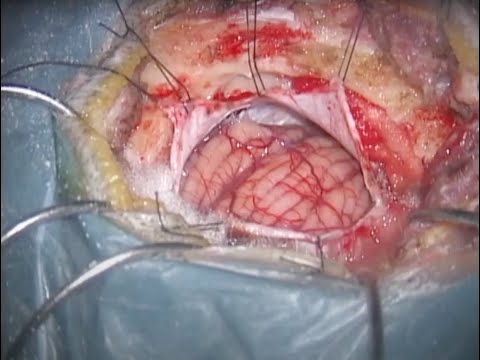 Microvascular decompression for trigeminal neuralgia caused by trigeminocerebellar artery