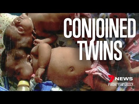 The heartwarming story of Trishna & Krishna: Conjoined twins separated