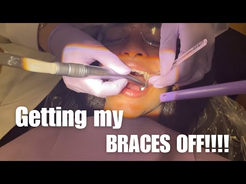 GETTING MY BRACES OFF