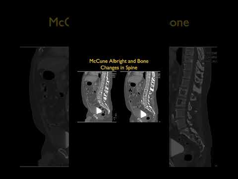 McCune Albright and Bone Changes in Spine