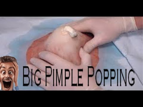 Big Blackheads-The best Pimple Popping-Large Blackheads-Deep  Blackheads Removal-Big Pimple Popping